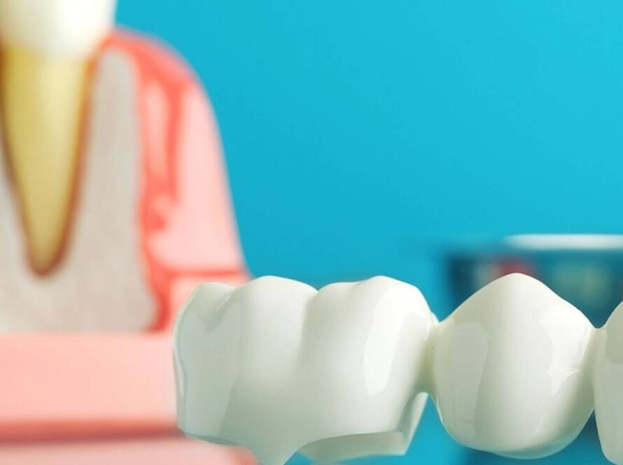Close-up of porcelain dental crown bridge with tooth anatomy model