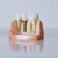 Best ways to care for your dental implants