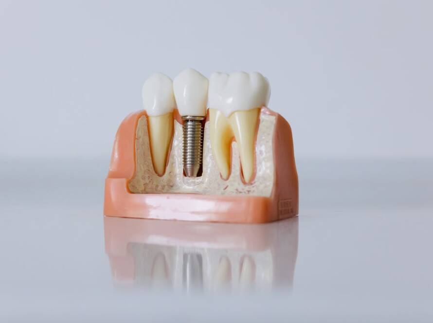 Dental implant model
