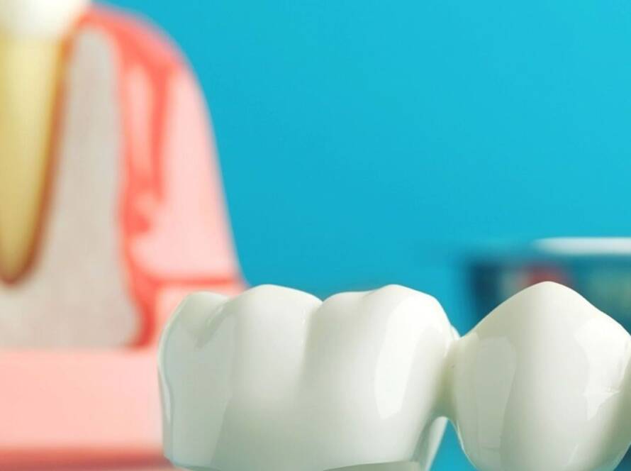 A dental crown